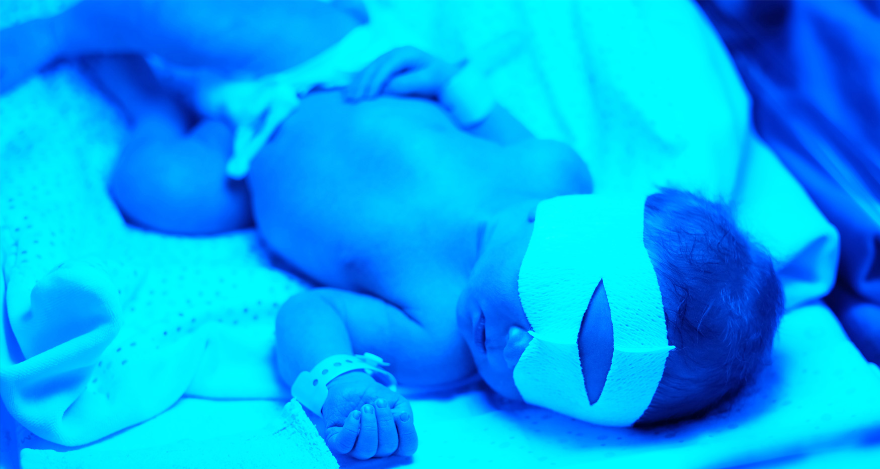 Care of the baby receiving Phototherapy - Neonatal Care Academy